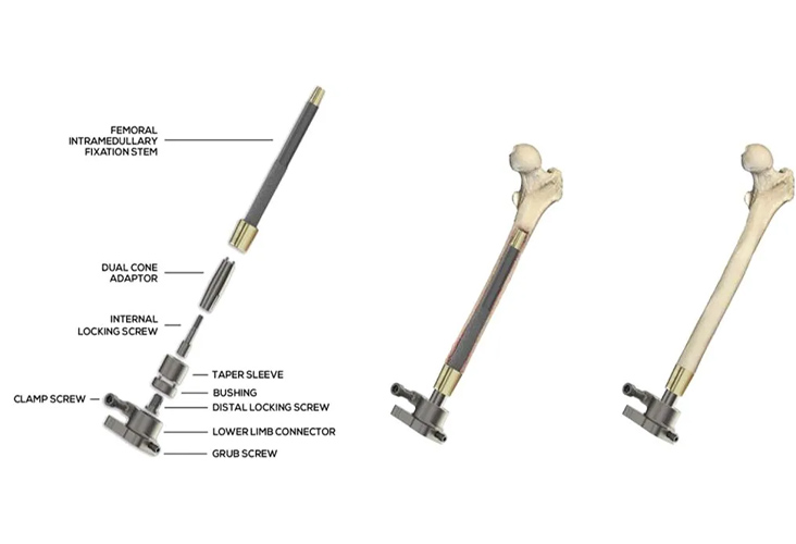 diagram of Osseointegration