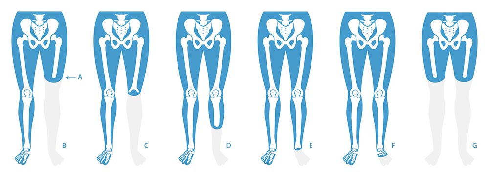 Different Types of Amputation